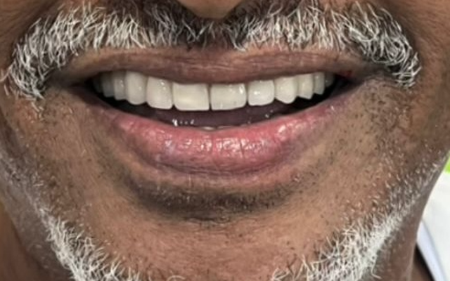 After Smile Transformation — Full Aesthetic Smile Restoration