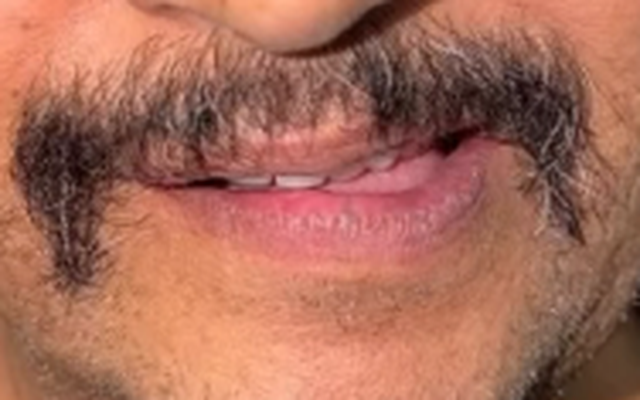 Before Smile Makeover — Worn Anterior Dentition