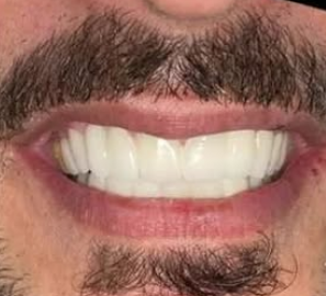 After Teeth Whitening — Bright Radiant White Smile