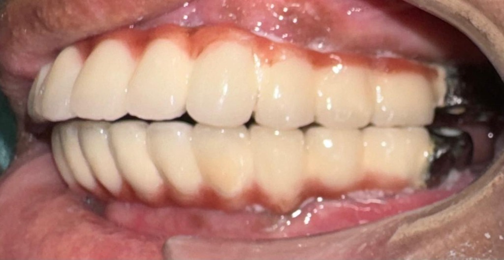 Before Alignment Correction — Lateral Bite Position